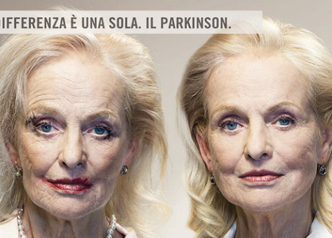 Cause Parkinson, un nuovo studio sui gemelli