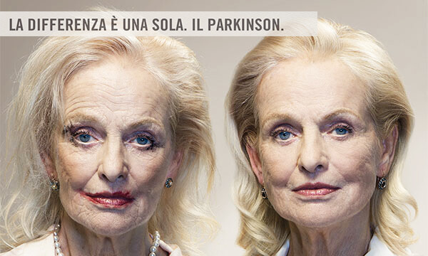 Cause Parkinson, un nuovo studio sui gemelli