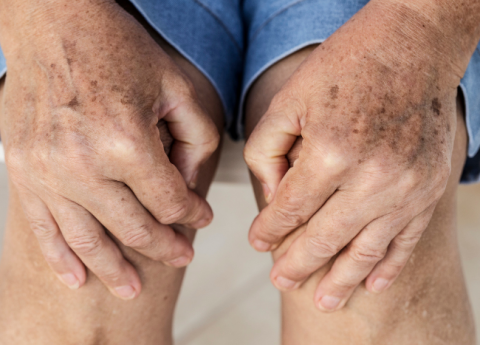 Pelle secca nelle gambe degli anziani: come intervenire in modo pratico