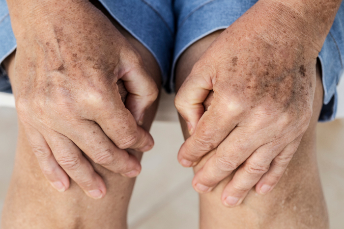 Pelle secca nelle gambe degli anziani: come intervenire in modo pratico